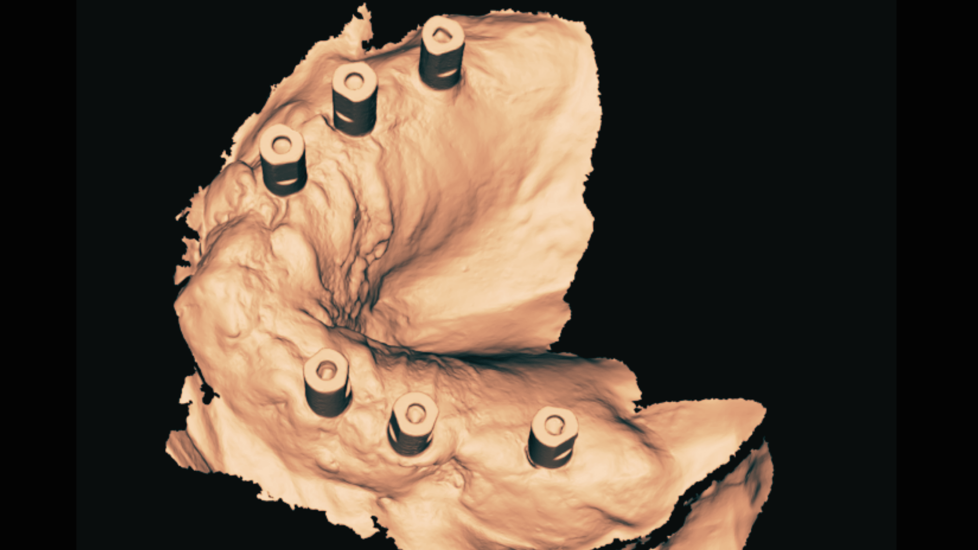 Lee más sobre el artículo Criterio para elegir ScanBodies. ¿Cuál me conviene?