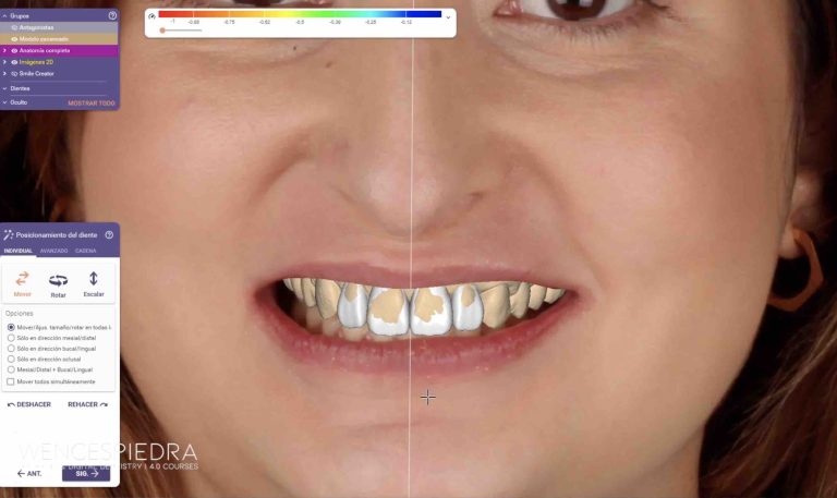 encerado-3d-exocad-smile-creator