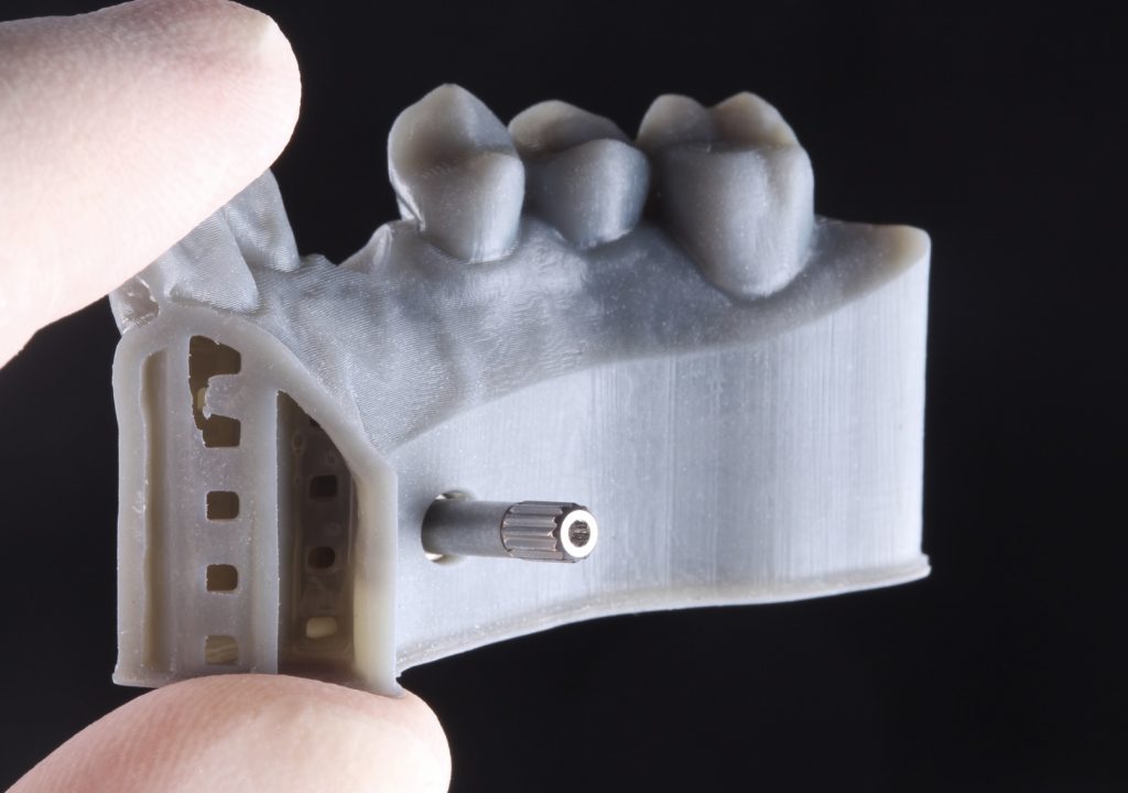 Modelo implante odontología digital Modelo implante odontología digital